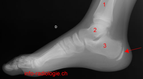 Calcaneum droit