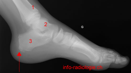 Calcaneum gauche