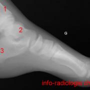 Calcaneum gauche