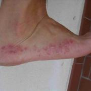 Dermatose du pied