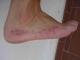 Dermatose du pied