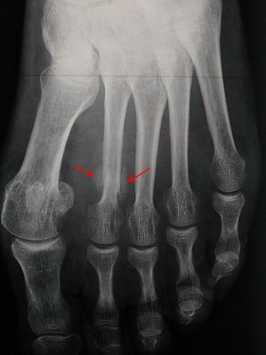 Fracture de fatigue site richard coffre