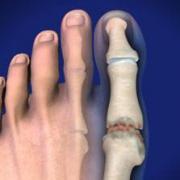 Hallux rigidus 