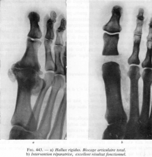 Hallux rigidus 1