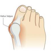 Hallux valgus