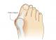 Hallux valgus