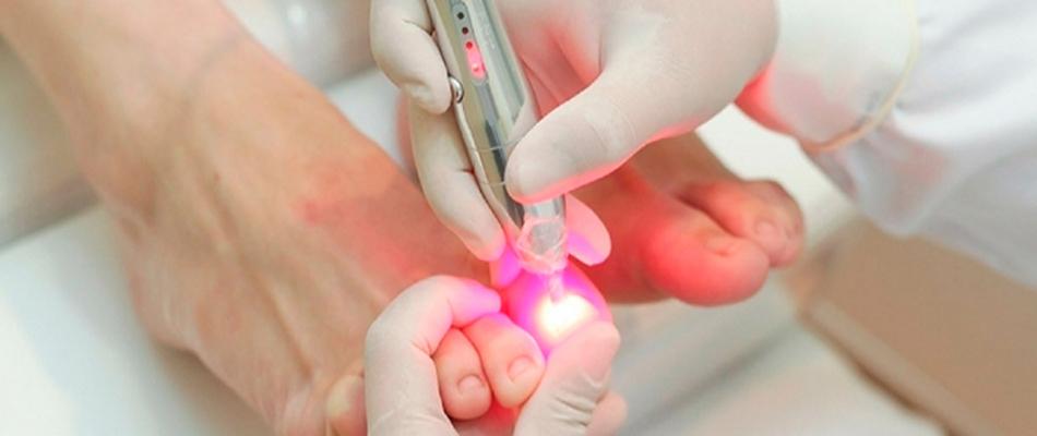 iKeener Dispositif Traitement Champignons Ongles,Approuvé FDA Laser  Thérapie Nettoyage d'entretien Ongle équipement,Soins Mains Pieds,Doigt  Réparateur Croissance Orteil,Guérir L'onychomycose Fongique : :  Beauté et Parfum