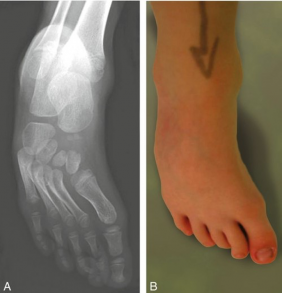 Metatarsus photo 2