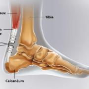 Ortho rupture achille