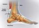 Ortho rupture achille