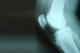 Radio osgood schlatter