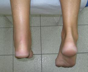 Rupture tendon achile en