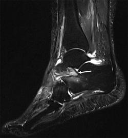 Scan sinus tarse