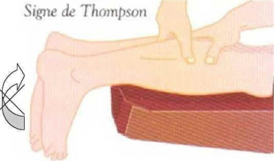 Signe de thompson
