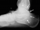 Synostose img 8