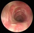 Tracheite endoscopy